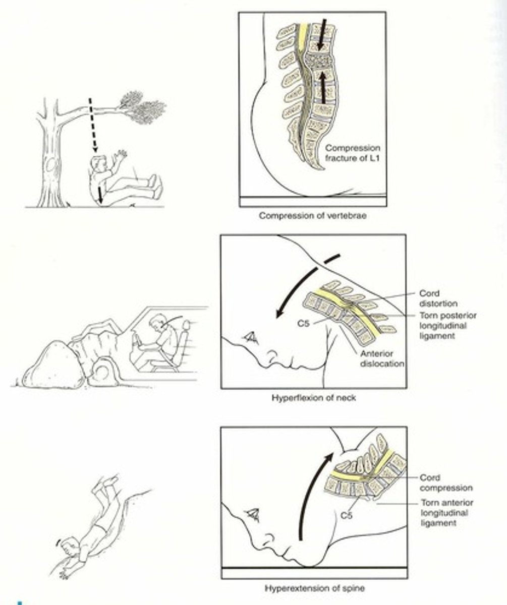 <p>Compression Fractures</p>