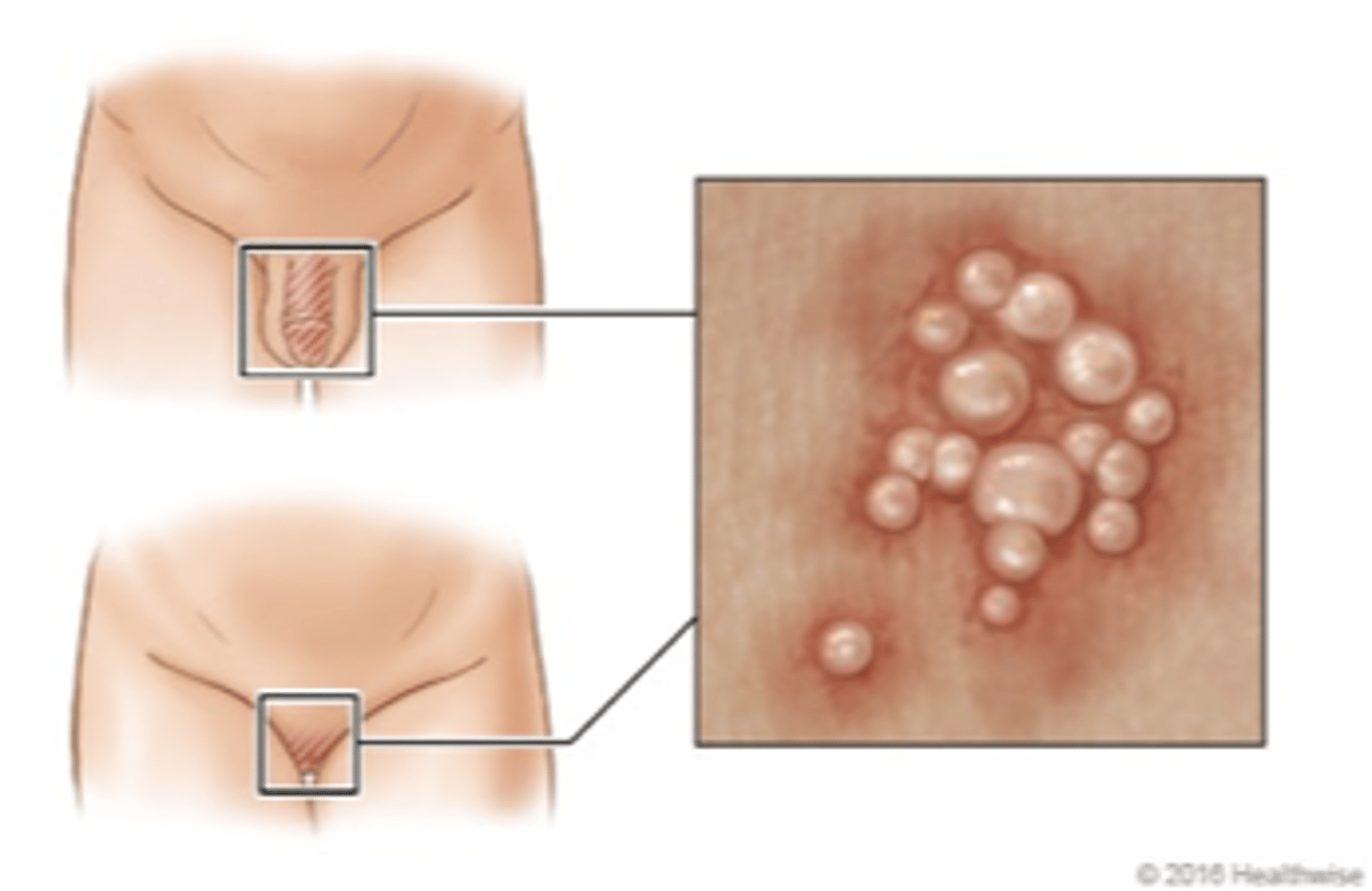 <p>name this skin pathology</p>