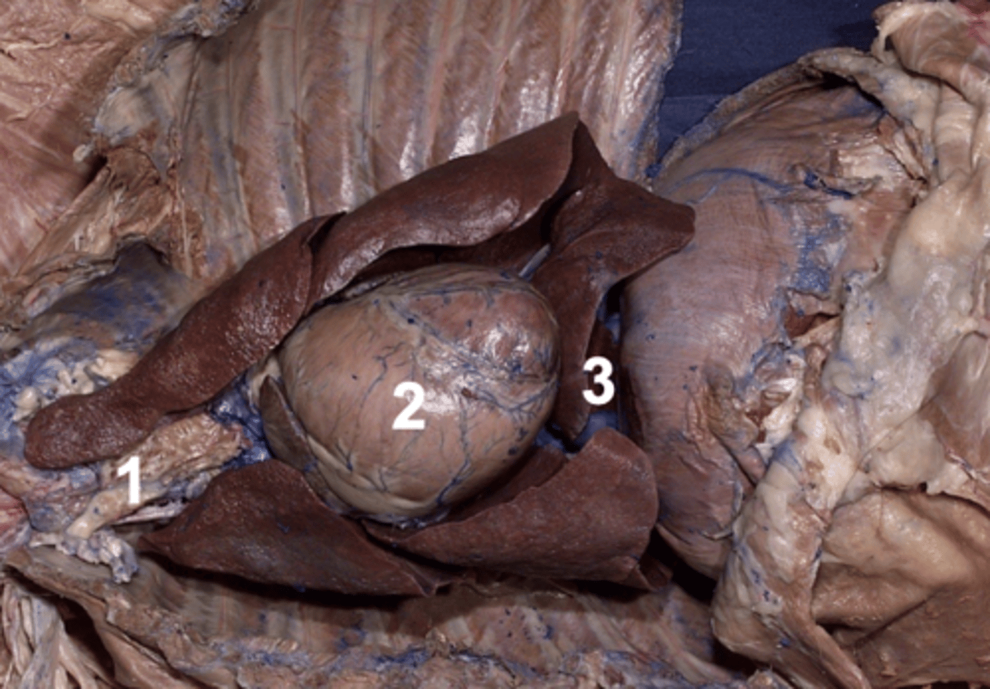 <p>Which section of mediastinum is 3?</p>