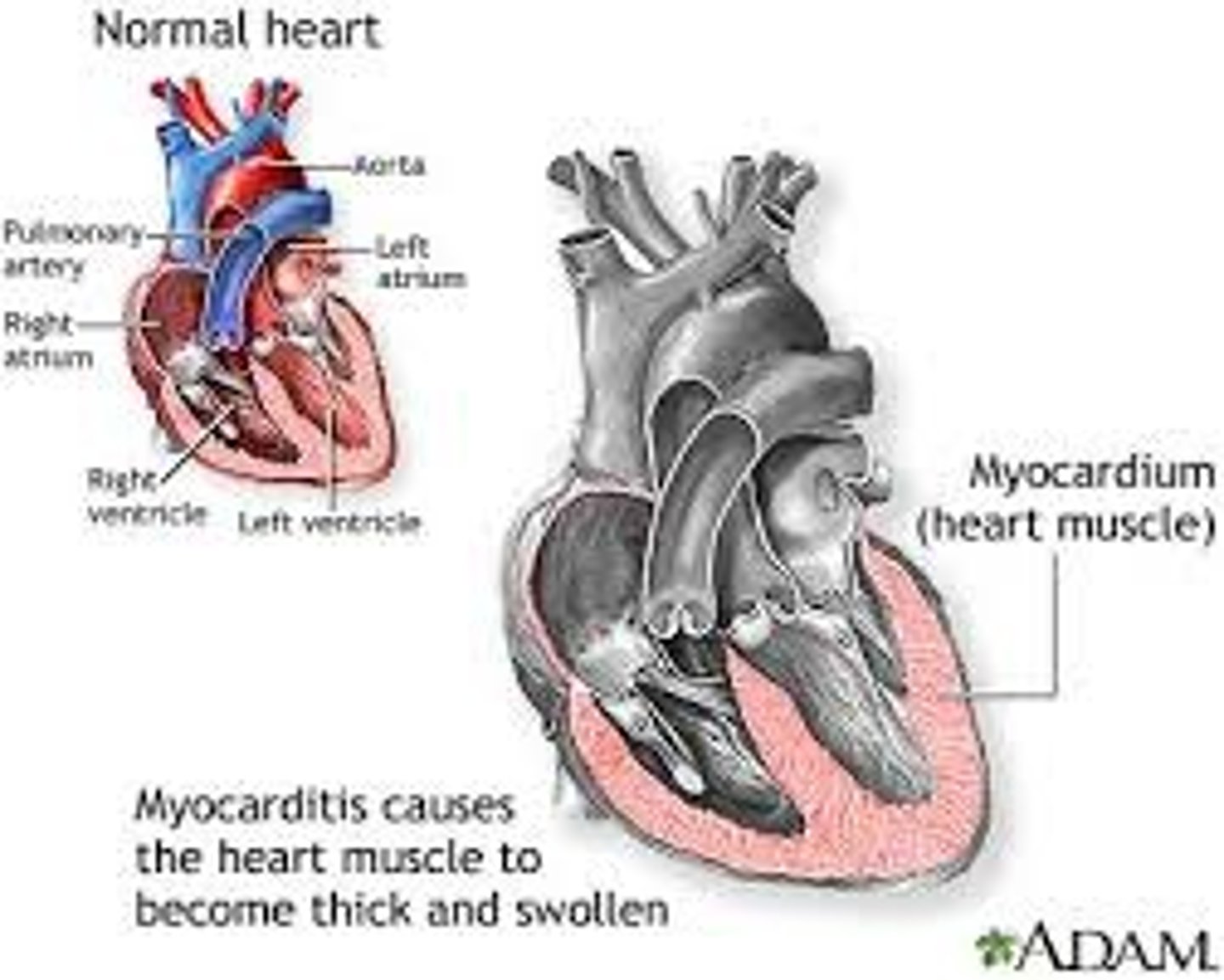 <p>-uncommon and poorly understood inflammation of myocardium</p><p>-causes the heart muscle to become thick and swollen</p><p>-penetration of an organism into the myocardium which causes muscle fiber disfunction</p><p>-organisms, blood cells, toxins, and immune substances damage the muscle</p><p>-associated with autoimmune disorders such as lupus</p>