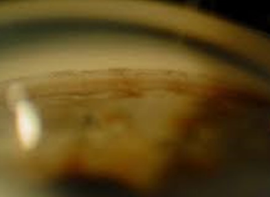 <p>what is the most posterior structure in this image &amp; what would you grade it? </p>