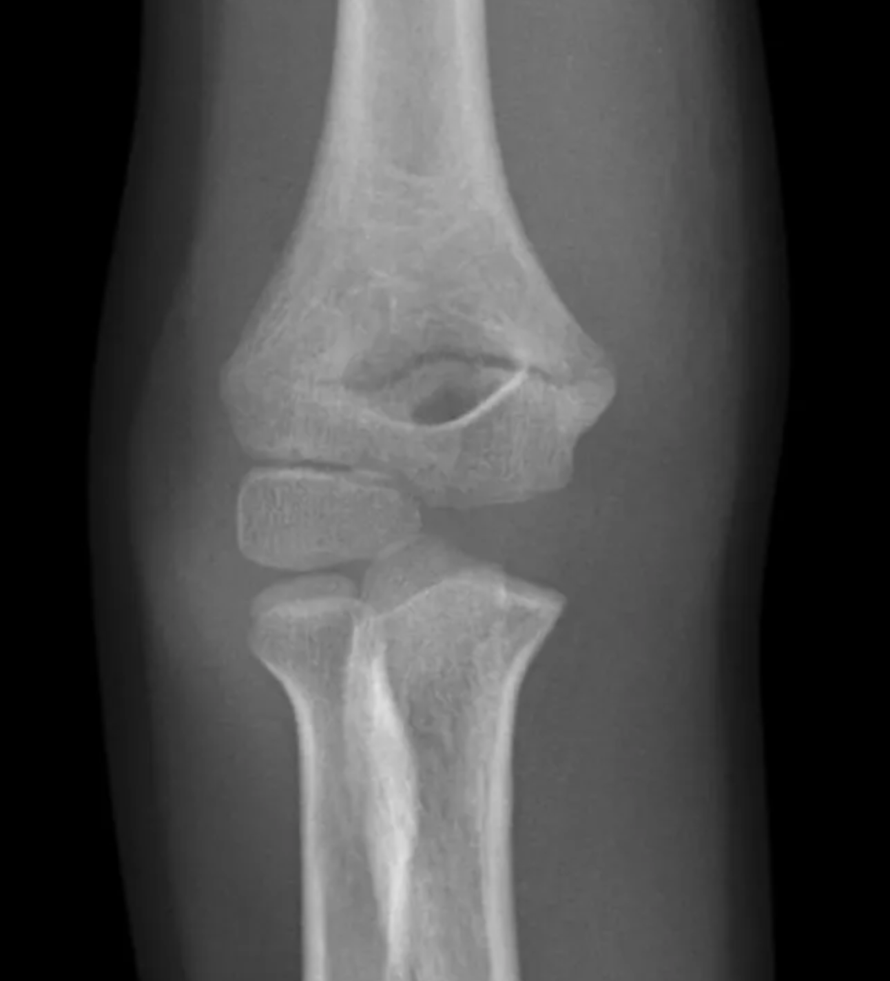 <p>Paediatric patient</p><ul><li><p>fall from the monkey bars, landing on extended hand</p></li><li><p>very painful elbow</p></li><li><p>Swelling and bruising is evident in the area </p></li><li><p>Unable to make an ‘OK’ sign (flexion of thumb IPJ and index finger DIPJ) </p></li><li><p>Weak radial pulse</p></li></ul><p></p>