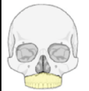 <p>What type of Le Forte fracture is this</p>