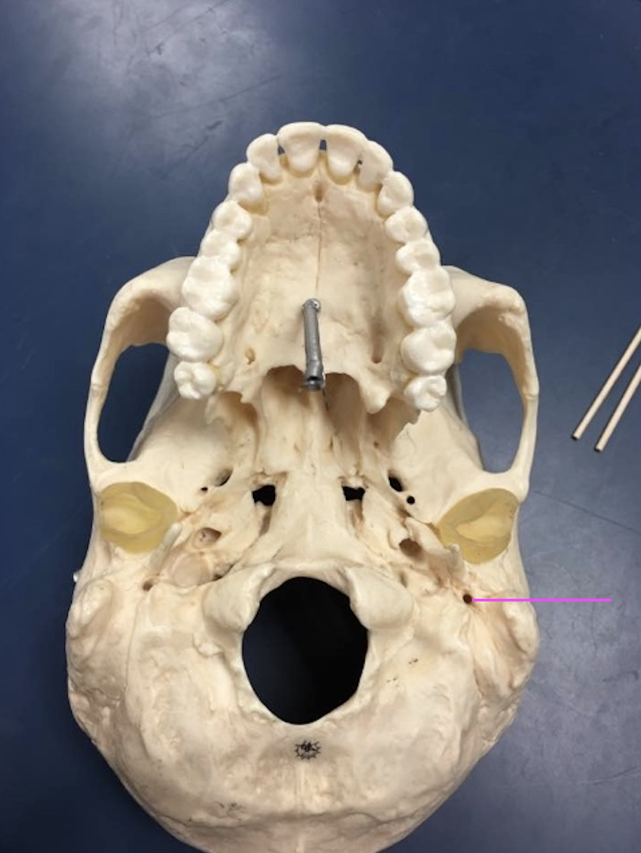 <p>What bone marking is this?</p>