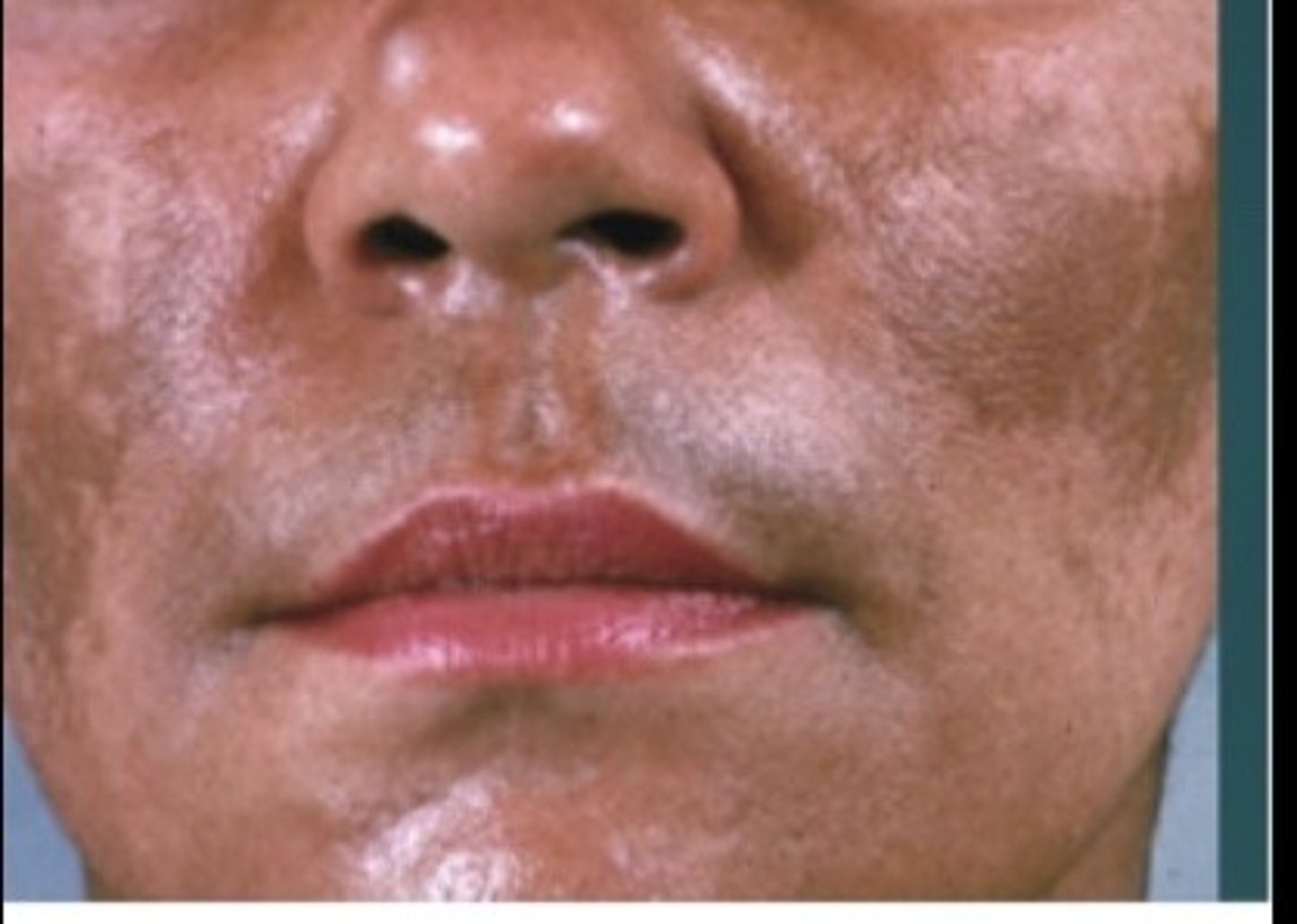 <p>Melasma</p>