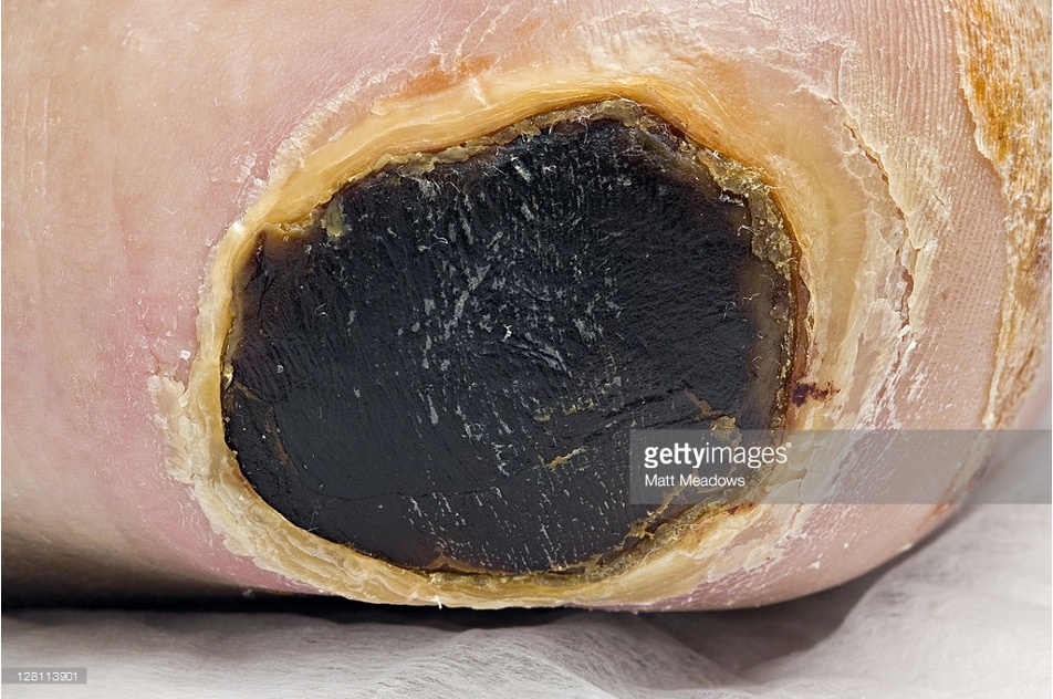 <p>Black, brown or tan devitalized tissue that adheres to the wound bed or edges &amp; may be firmer or softer than surrounding skin</p>