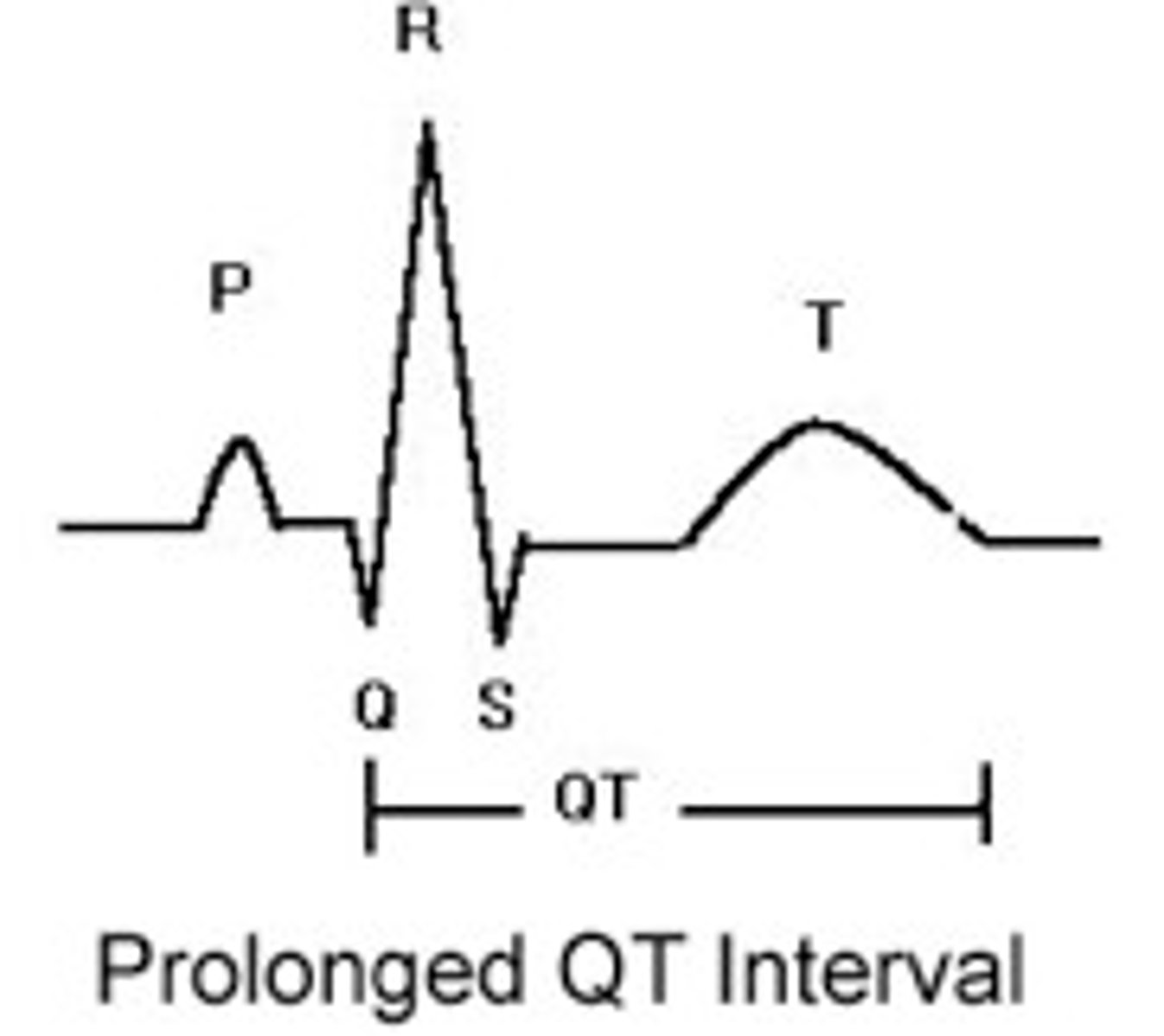 <p>(not healthy (not taking vit like Ca++) so look like a hipo which is large -&gt; long QT)</p>