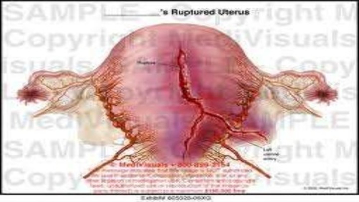 <p>rupture of the uterus</p>