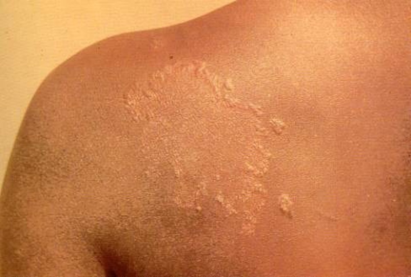 <p>Pathogen: Mycobacterium leprae</p><p>S+S:</p><p><strong>skin</strong>: Flat, discolored patches on skin, ulcers on the feet, nodules on the face, loss of eyebrows/eyelashes,</p><p><strong>mucous membranes</strong>: stuffy nose, epistaxis,</p><p><strong>peripheral nerves</strong>: numbness, paralysis</p><p><strong>limbs</strong>: shortening of fingers and toes</p><p>Reservoir: Armadillos</p><p>Transmission: Long term inhalation of respiratory secretions; touching/handling infected armadillos</p>