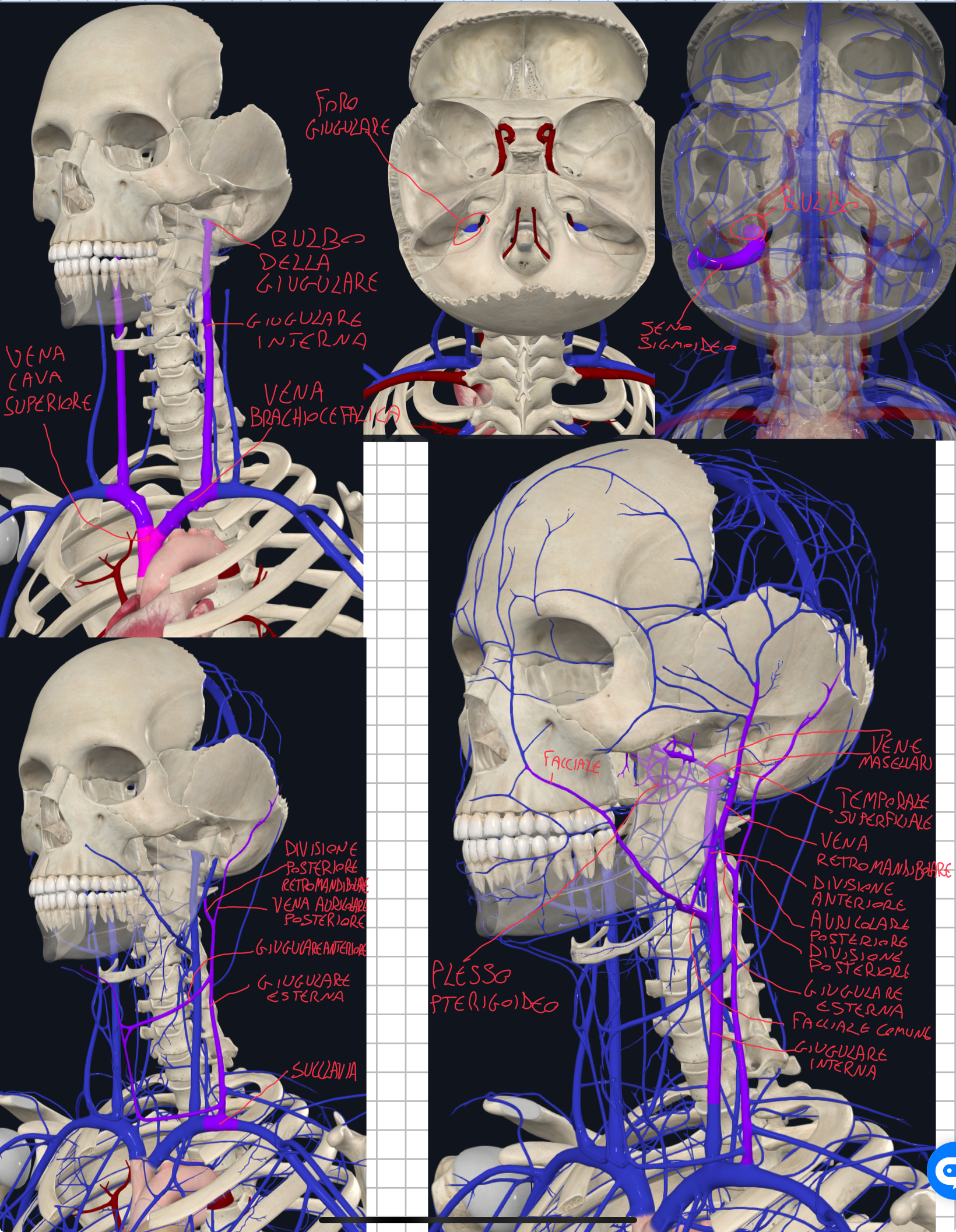 <p>VENA GIUGULARE INTERNA:</p><ul><li><p>Vena principale del collo</p></li><li><p>Origina dal bulbo della giugulare (che si estende dal Seno Sigmoideo) e passa attraverso il Foro Giugulare (tra occipitale e temporale)</p></li><li><p>Riceve sangue dai seni venosi della dura madre, quindi sangue endocranico</p></li><li><p>Scende all’interno della guaina carotidea che contiene inoltre la carotide (che sale) e il nervo vago</p></li><li><p>Alla base del collo va ad unirsi alla VENA SUCCLAVIA formando la VENA BRACHIOCEFALICA che insieme alla sua controlaterale formano la VENA CAVA SUPERIORE</p></li><li><p>E’ la via di drenaggio principale dell’encefalo e strutture profonde del collo</p></li></ul><p>VENA GIUGULARE ESTERNA:</p><ul><li><p>Origina dall’unione della Divisione Posteriore della Vena Retromandibolare + Vena Auricolare Posteriore</p></li><li><p>Decorre superficialmente sullo Sternocleidomastoideo</p></li><li><p>Sbocca nella VENA SUCCLAVIA</p></li><li><p>Raccoglie sangue dalla regione occipitale e nucale</p></li><li><p>Da essa sbocca la VENA GIUGULARE ANTERIORE, che origina nei pressi dell’osso ioide e raccoglie sangue dal collo superficiale</p></li></ul><p>PLESSO VENOSO PTERIGOIDEO → VENA RETROMANDIBOLARE:</p><ul><li><p>Si trova nella Fossa Intratemporale e riceve sangue dai territori dell’arteria mascellare</p></li><li><p>Da esso originano le VENE MASCELLARI che unendosi alla VENA TEMPORALE SUPERFICIALE formano la VENA RETROMANDIBOLARE che si divide in una DIVISIONE ANTERIORE e una POSTERIORE</p></li><li><p>DIVISIONE POSTERIORE che insieme alla VENA AURICOLARE POSTERIORE formano la GIUGULARE ESTERNA.&nbsp;</p></li><li><p>DIVISIONE ANTERIORE che sbocca nella VENA FACCIALE COMUNE che a sua volta si connette con la GIUGULARE INTERNA.</p></li></ul><p></p>