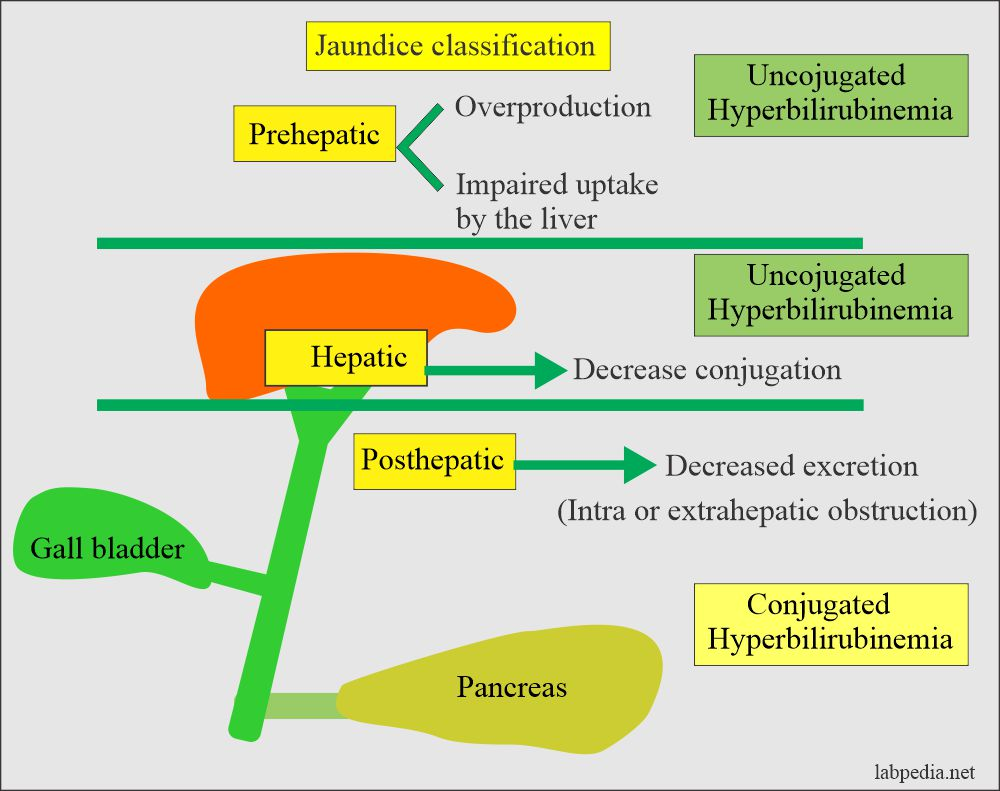 <ul><li><p><strong>Leversjukdomar</strong>: Det beror på en nedsatt förmåga att konjugera bilirubin från blodet i hepatocyterna. Det kan bero på levercirros eller Mb Gilbert (genetiskt). Ger hyperbilirubinemi med okonjugerat bilirubini blodet med gulsot. </p></li><li><p><strong>Stasikterus</strong>: Beror på stas i gallgångarna av olika anledningar; PBC, PSC, gallsten eller  pankreastumör. Det ger minskad utsöndring av konjugerat bilirubin till tarmen → stas tryck som leder till läckage i blodet → gulsot. </p></li></ul><p></p>