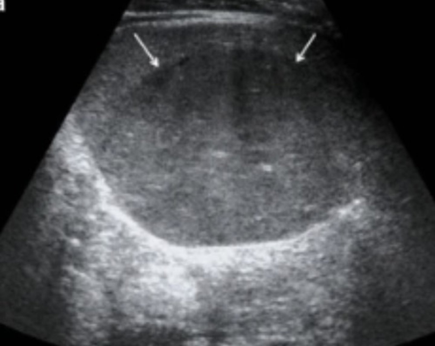 <p>Benign splenic tumor</p><p>Associated with syndromes</p><p>Homogeneous</p><p>Solid</p><p>Well-defined</p><p>Variable echogenicities</p>