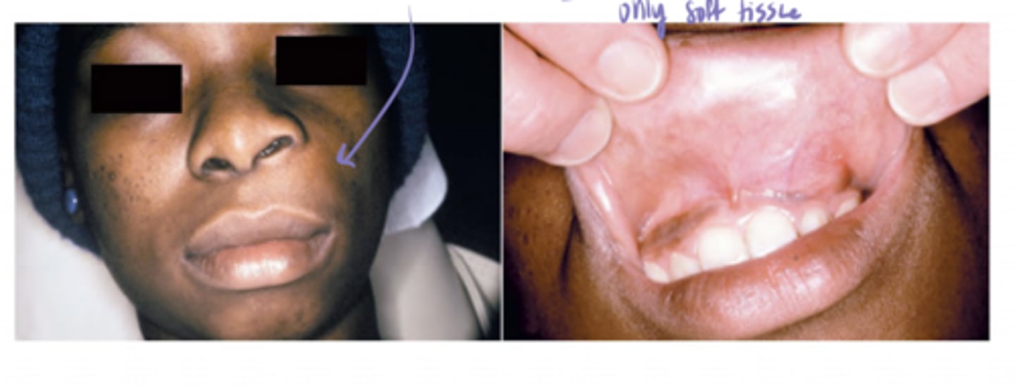 <p>complete surgical excision (rare recurrence)</p>