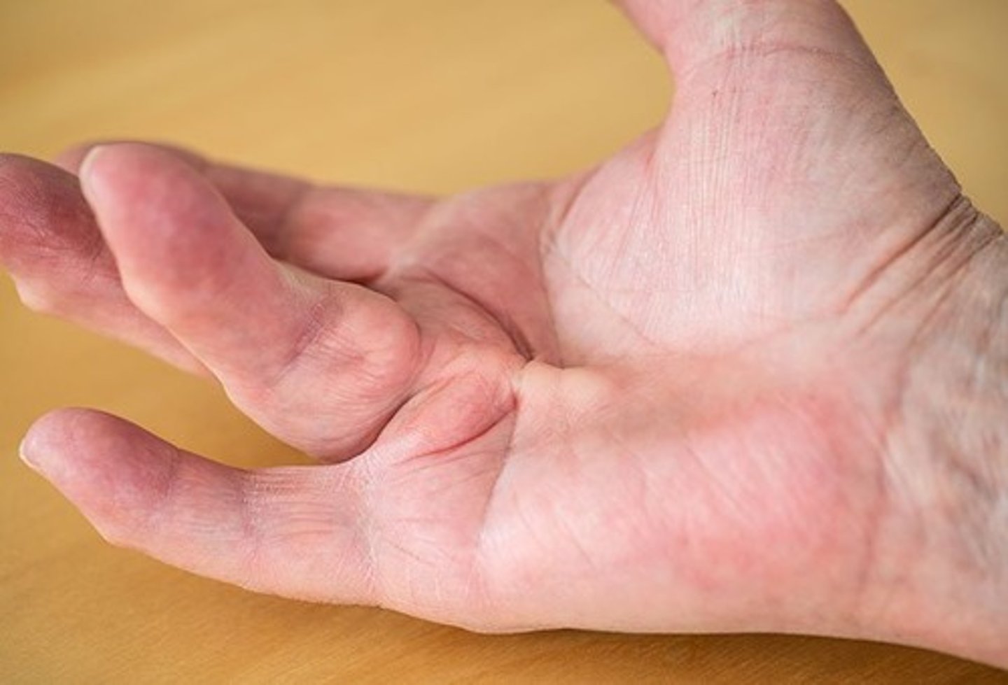 <p>Which of the following is a genetic predisposed fibrosing disorder that causes contracture of the palmar fascia due to nodules &amp; cords at the MCPs &amp; PIPs?</p><p>a. Carpal tunnel syndrome</p><p>b. De Quervain's tenosynovitis</p><p>c. Boutonniere deformity</p><p>d. Dupuytren's contracture</p>