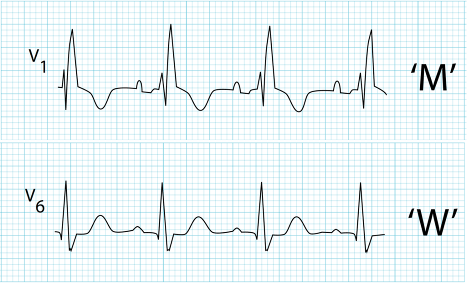 <p>What does this refer to</p><ul><li><p>EKG Diagnostic Criteria</p><ul><li><p>QRS duration &gt; 120ms</p></li><li><p>RSR’ pattern in V1-3 (“M-shaped” QRS complex)</p></li><li><p>Wide, slurred S wave in lateral leads (I, aVL, V5-6)</p></li></ul></li></ul><p></p>