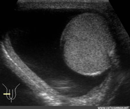 <p><span><span>THIS IMAGE REPRESENTS WHICH OF THE FOLLOWING:</span></span><br><span><span>testicular trauma</span></span><br><span><span>free fluid in the testicle</span></span><br><span><span>hydrocele</span></span><br><span><span>normal scrotum</span></span></p>