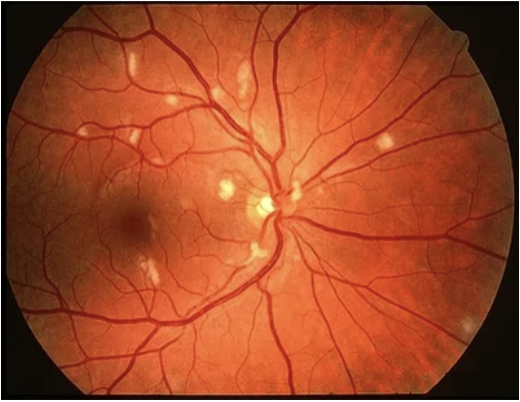 <p>What would find you on a funduscopic exam of a pt w/ HIV retinopathy?</p>