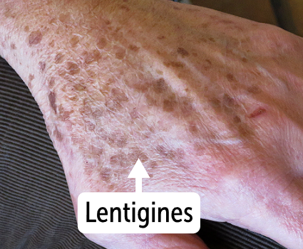 <p>skin lesions which are <strong>macules, </strong>that are <span>hyperpigmented, flat, and &lt;1 cm wide</span></p><ul><li><p><strong>resemble lentils and looks like big freckles </strong></p></li><li><p>The hyperpigmented macules are known as <strong>lentigines, with a circular sharp border </strong></p></li></ul><p></p>