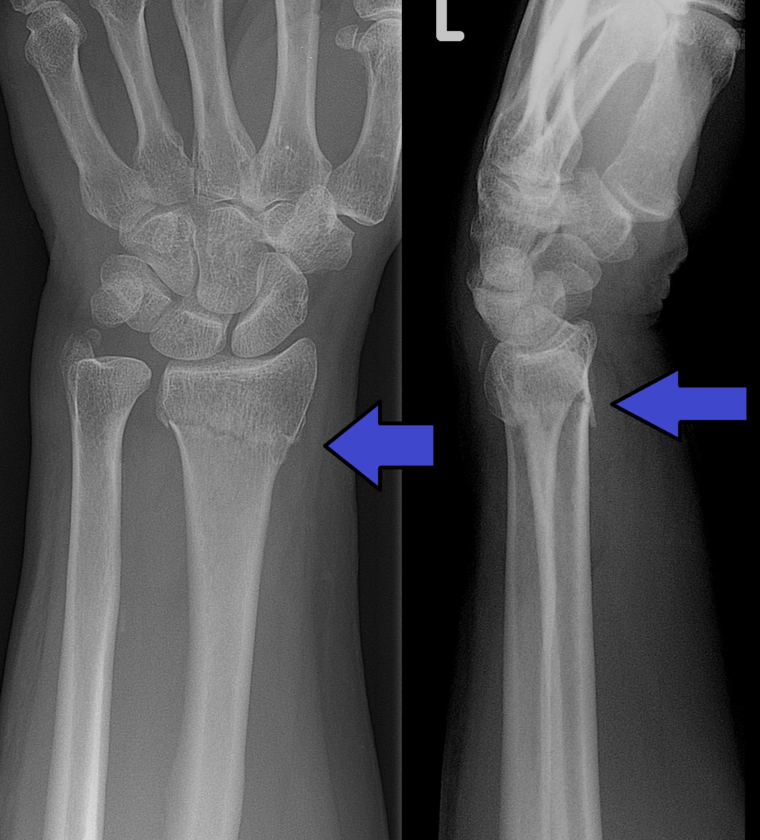 fracture of the distal radius at the wrist
