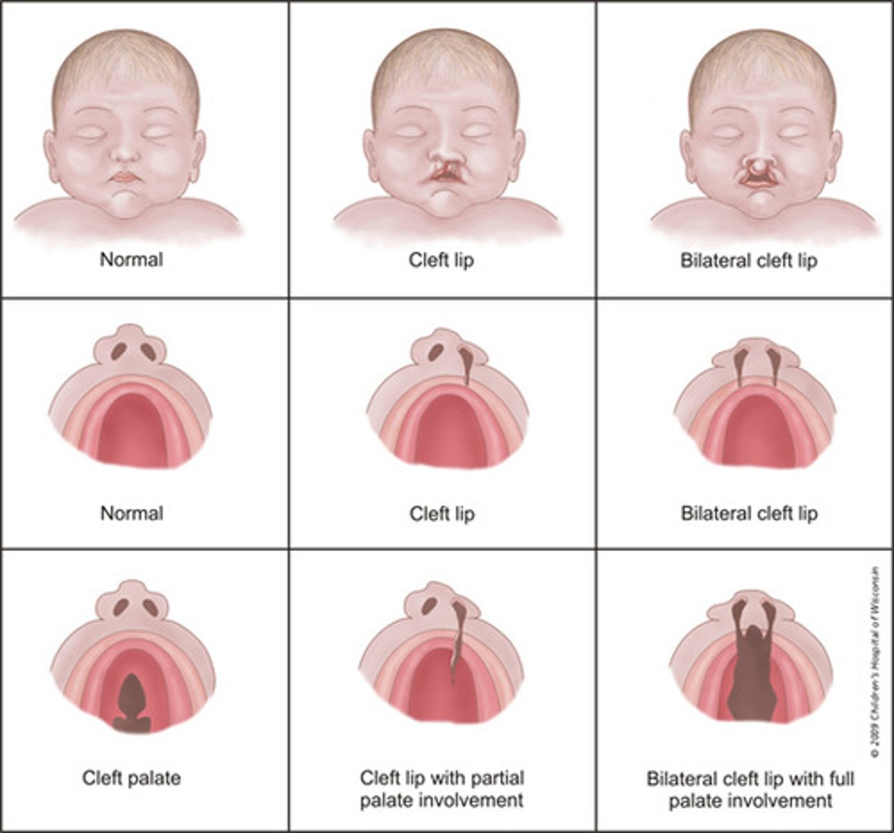 <p>Its an OPENING in a normally closed structure. Often associated with cleft lip (an opening in the lip). However cleft palate is not often associated with cleft lips.</p>