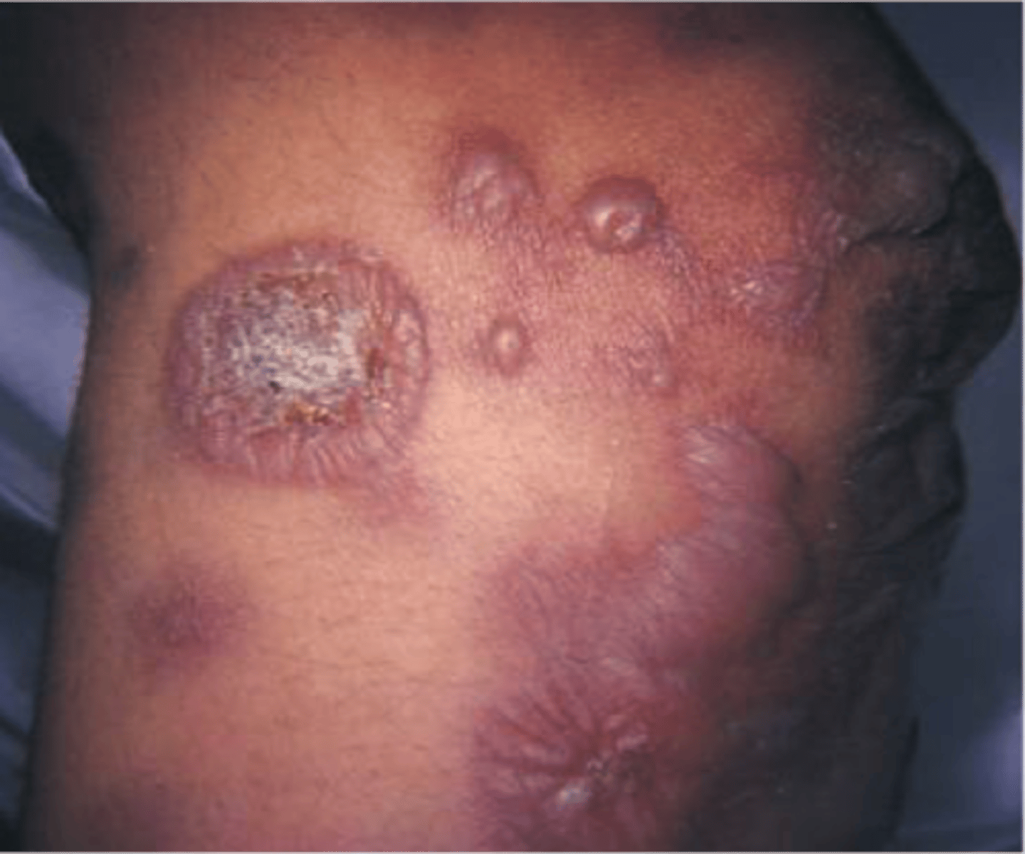 <p>erythema multiforme</p>