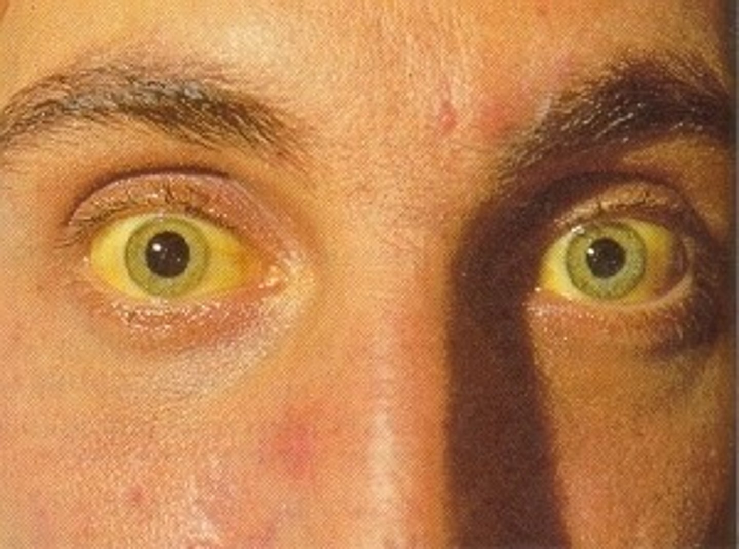 <p>Bilirubin circulating in the blood attached to plasma proteins --> insoluble</p>