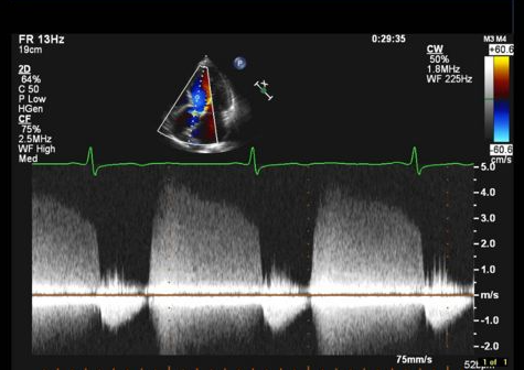 <p>Identify the spectral Doppler waveform:</p>