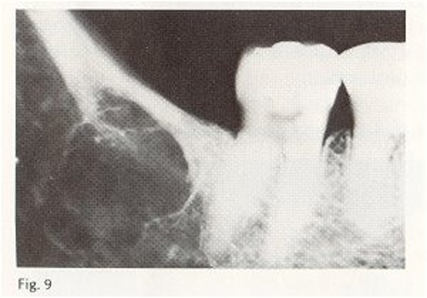 <p>not a pathologic process but radiographic features can be confused with pathology</p><p>radiolucent area with fine central trabeculation within the lesion</p>