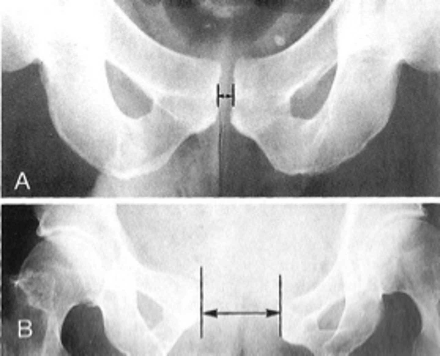 <p>Clinical significance of a widened symphysis pubis</p>