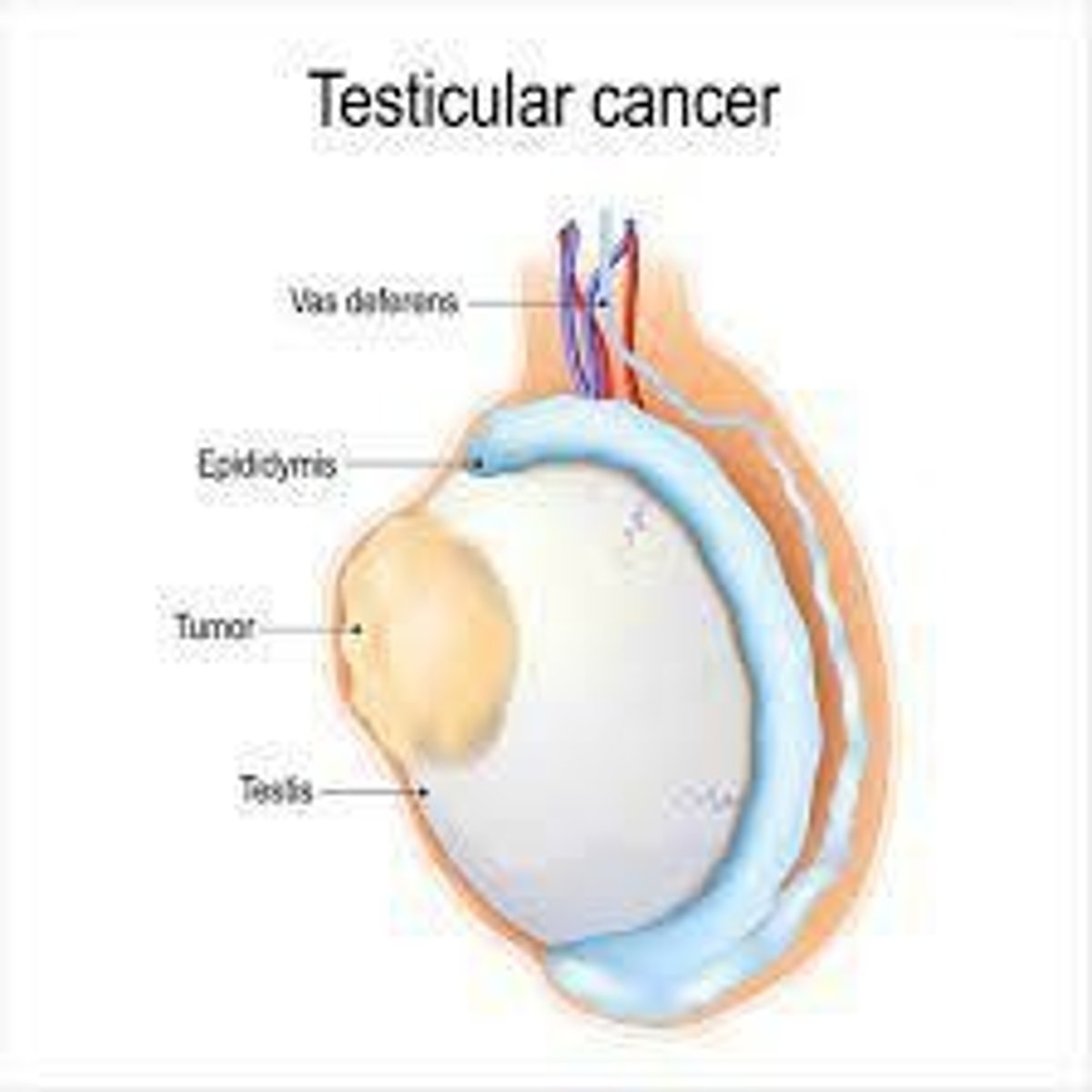 <p>Painless swelling, growth/mass, pain in the testicle.</p>