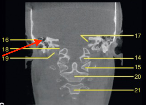 <p>identify the HYPOdense structures </p>