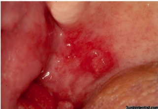 <p>painless, erythematous, velvety patch most commonly found on the mouth floor, ventral aspect of the tongue, or the soft palate</p><p>-90% of cases are dysplasia or carcinoma</p>