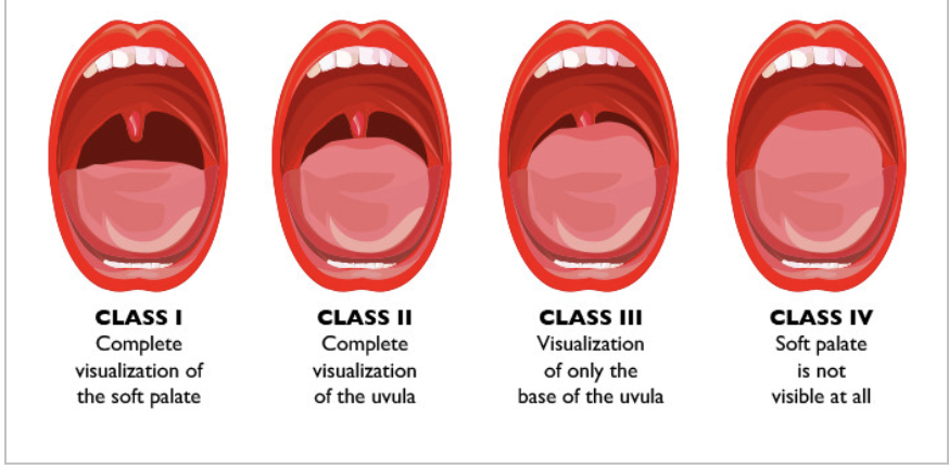 <p>Class 1: Complete visual of soft palate</p><p>Class 2: Complete visual of uvula but not soft palate</p><p>Class 3: Visual only base of uvula</p><p>Class 4: Soft palate not visible at all</p>