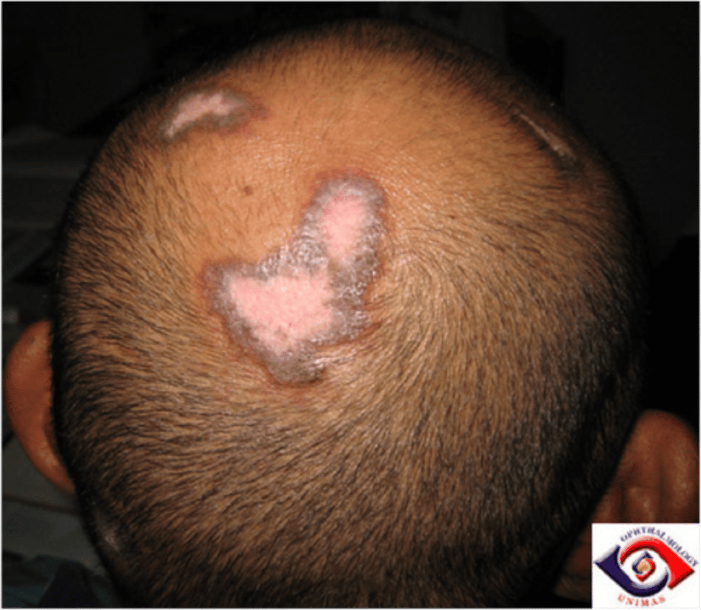 <p>diagnose this:</p><p>Inflammation destroys hair follicles, leading to scarring of the follicle and permanent hair loss</p>