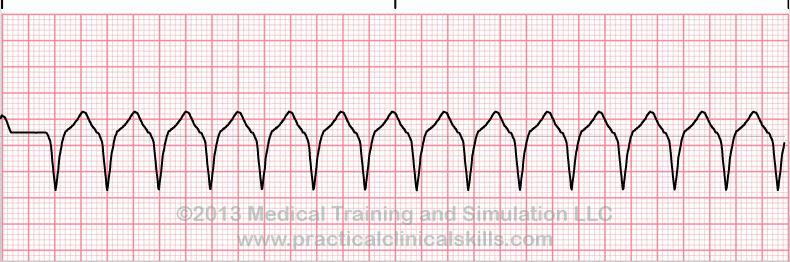 <p>what is this heart rhythm?</p>