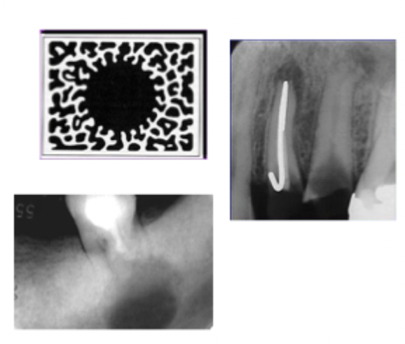 <p>The lesion does not exhibit a thin radiopaque rim of bone at the periphery. The periphery appears fuzzy or poorly defined. May represent a benign or malignant process. </p>