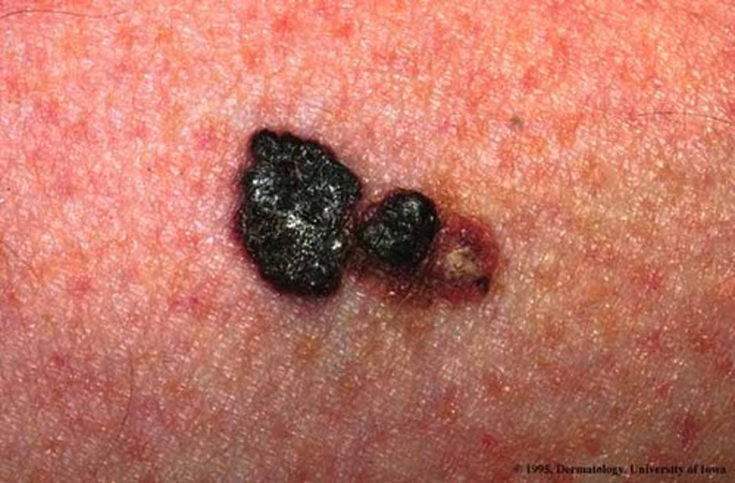<p>non smooth or notched margins (malignant melanoma)</p>