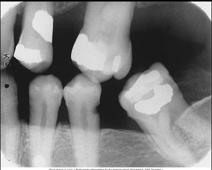 <p>Identify the carious lesion.&nbsp;</p>