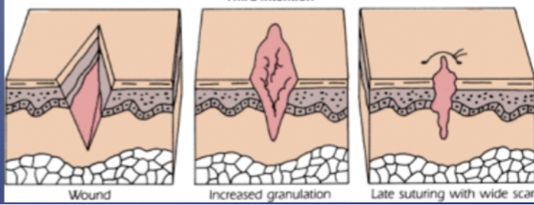 <ul><li><p><span>Delayed closing&nbsp;</span></p></li><li><p><span>Granulation starts and then closure&nbsp;</span></p></li></ul>