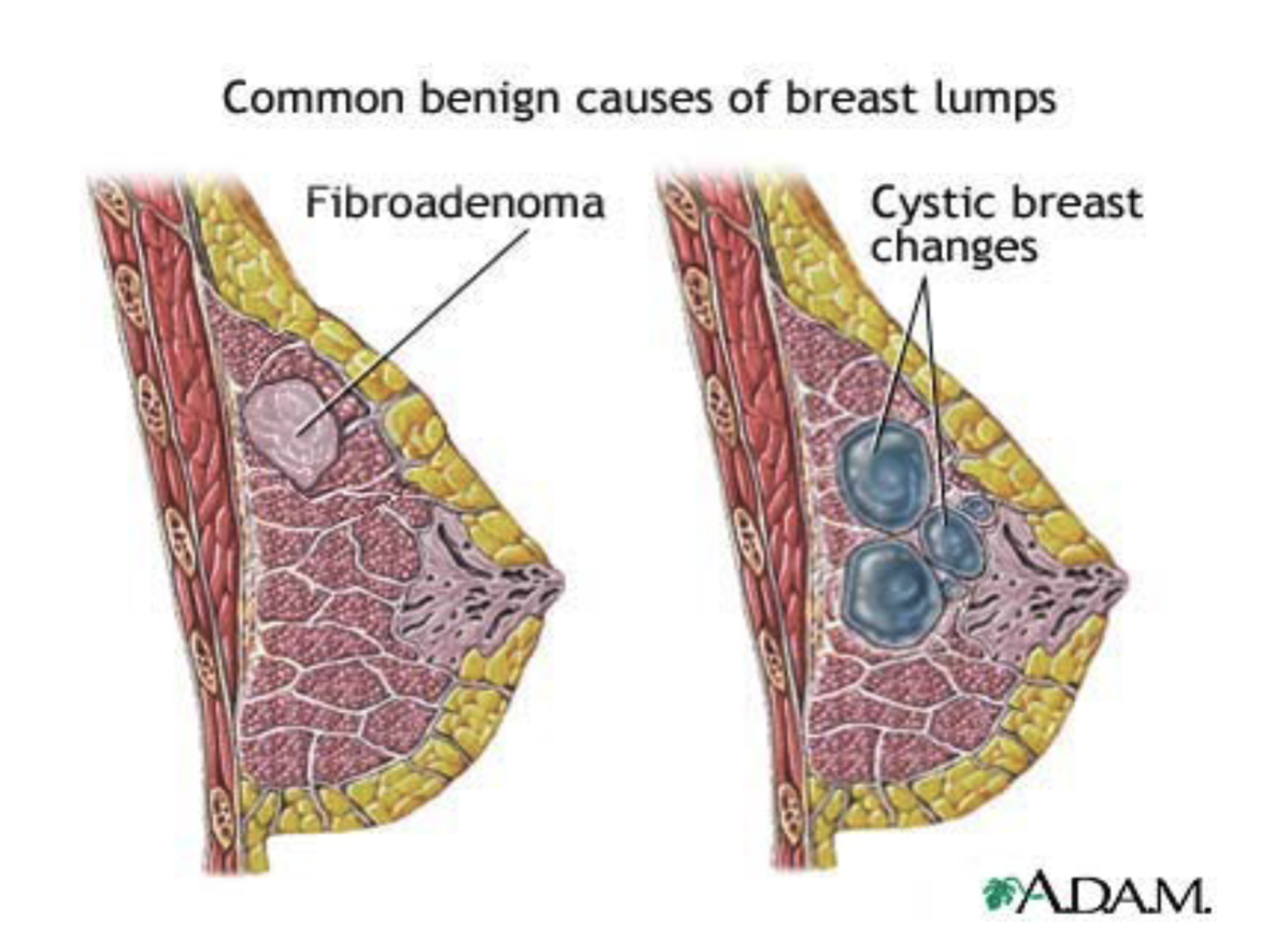 <p>benign (non-cancerous breast changes caused by hormonal fluctation that create cysts, fibrosis, and tissue thickening</p>