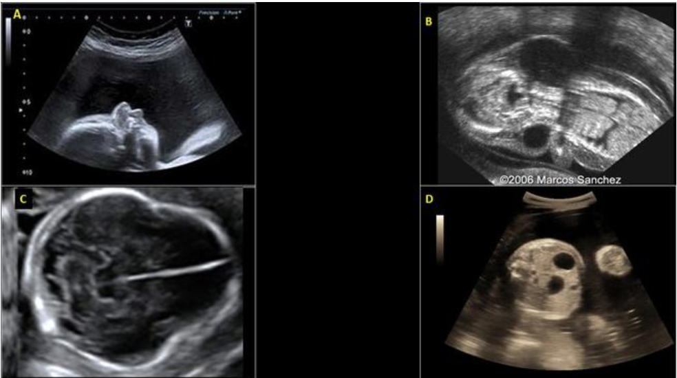 <p>which image is turner syndrome</p><p>a) A</p><p>b) B</p><p>c) C</p><p>d) D</p>