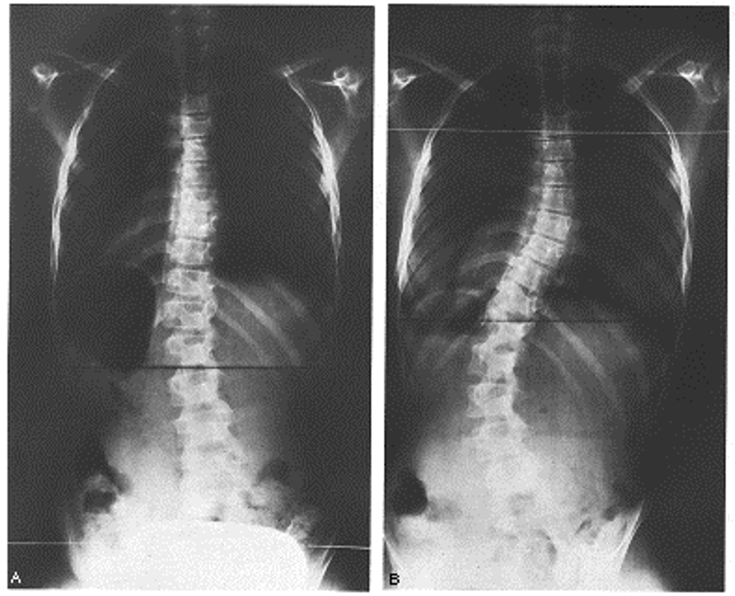 <p>Decreased lung capacity </p>