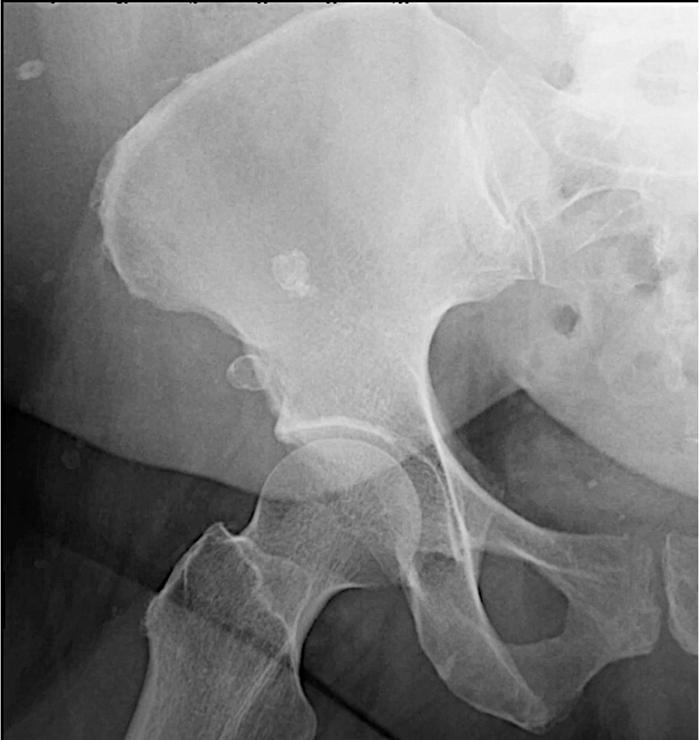 <p>multiple calcified lesions overlying and next to the ileum</p><ul><li><p>MC cause of calcifications in gluteal region</p></li><li><p>IM injection → fat necrosis and dystrophic calcifications → visible granulomas</p></li></ul><p></p>
