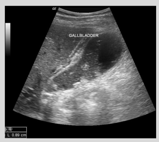 <p>Describe the preferred radiologic approach to detect gallstones and acute cholecystitis</p>