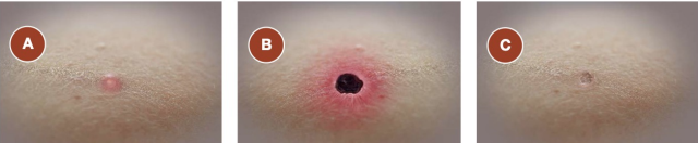 Stages of __________ - an important and early clinical feature of some rickettsial diseases.