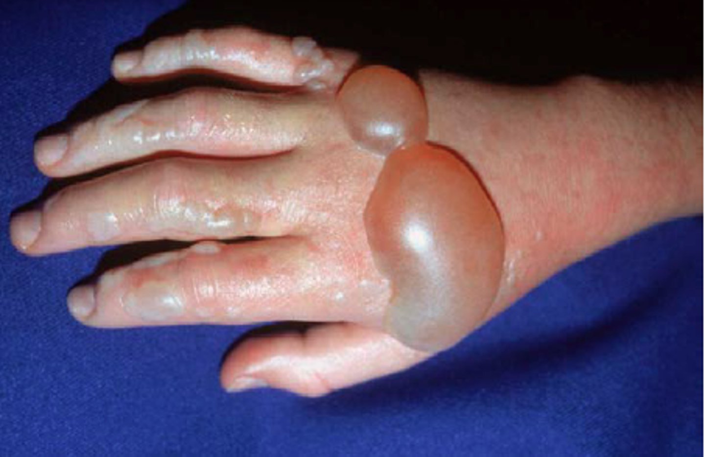 <p>Watery: contains fluid, some proteins, and white blood cells</p>