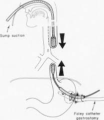 <p>Dilation of a stricture using a probe or dilator of gradually increasing diameter.</p>