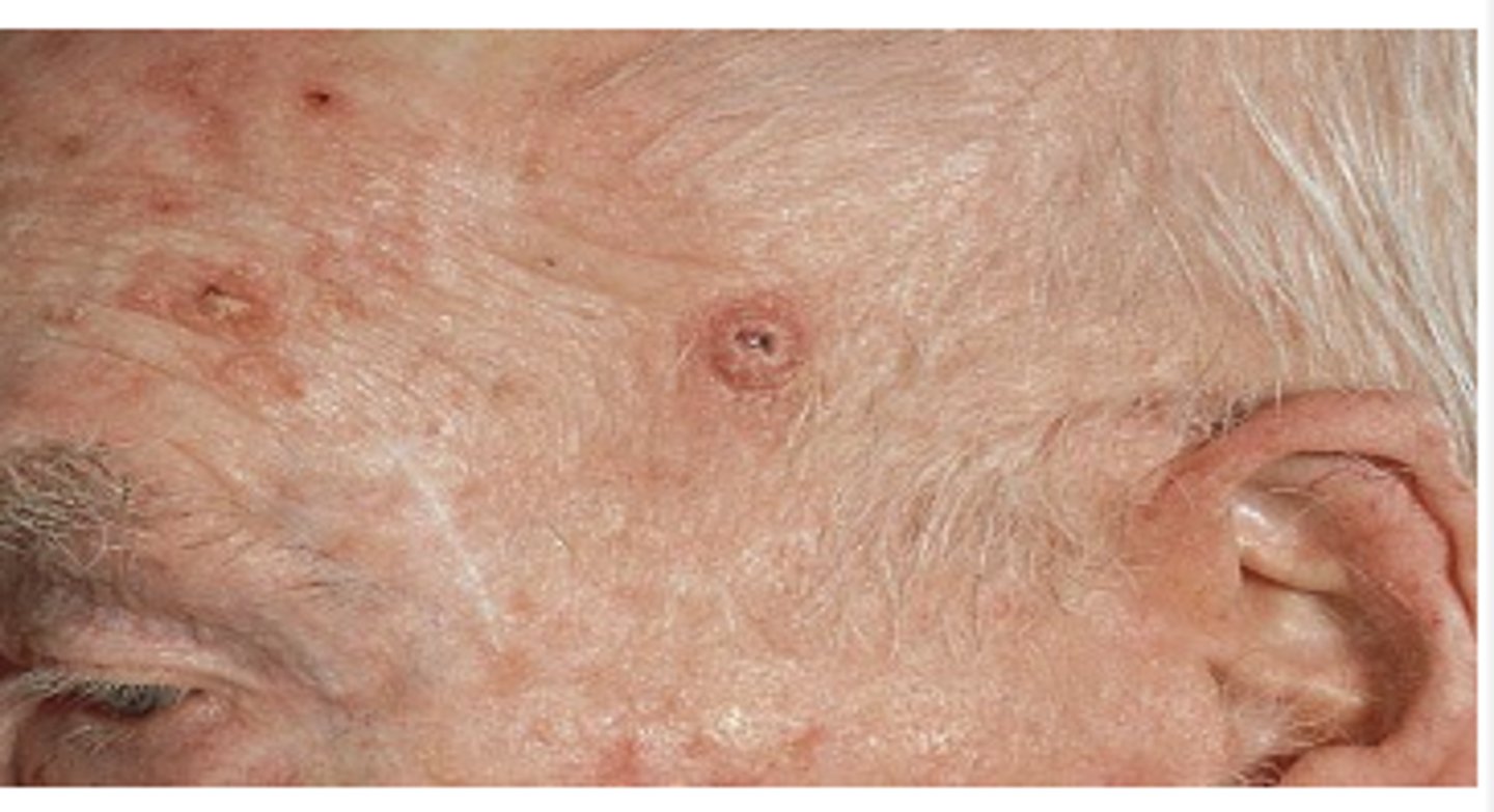 <p>What is the cause of basal cell carcinoma (BCC)?</p>