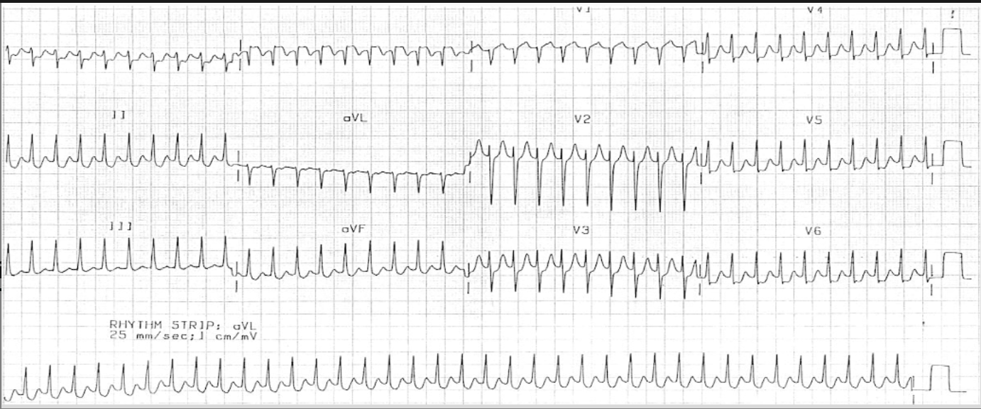 <p>narrow QRS, no P wave</p>