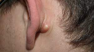 <p>What type of skin lesion is this? Give an example.</p>